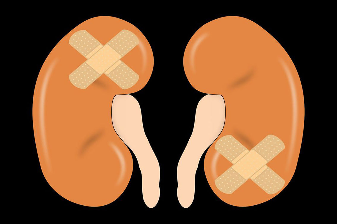 Illustration of two kidneys, each with a crossed bandage, representing kidney injury or disease.